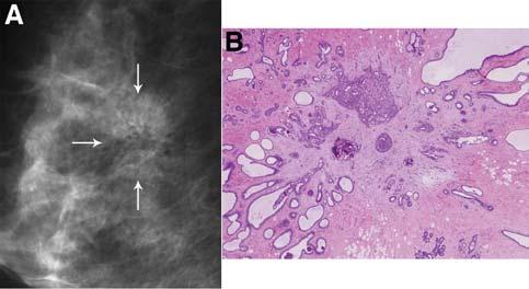 442 Benign Breast Diseases postmortem study by Nielsen et al. [81], these lesions were commonly associated with benign breast diseases, whereas Jacobs et al.