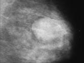 but significant proportion of breast cancers will not be diagnosed on imaging alone and clinical opinion is crucial in determining whether further testing such as biopsy is needed, despite normal