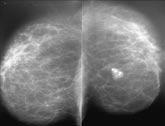 Breast ultrasound commonly reported findings Cysts Cysts are extremely common findings on ultrasound, particularly in women in their 40s.