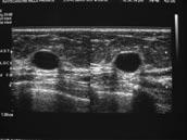 Cysts may be simple (with typical sonographic features of a cyst [Figure 14]), or complex cystic lesions (which have atypical features such as thickened walls [Figure 15]).