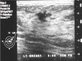 margin or features suggesting it may be solid, or have a solid component (eg. an internal nodule). 12,13 Hypoechoic lesions Hypoechoic lesions are frequently identified on ultrasound.