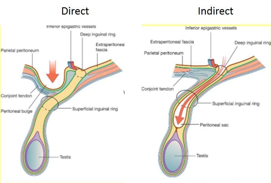 * Differences between Direct and Indirect hernias: 1. Origin and coarse: 2. Content: Direct: Develops in the area of Hasselbach's triangle. The origin is medially to the inferior epigastric vessels.