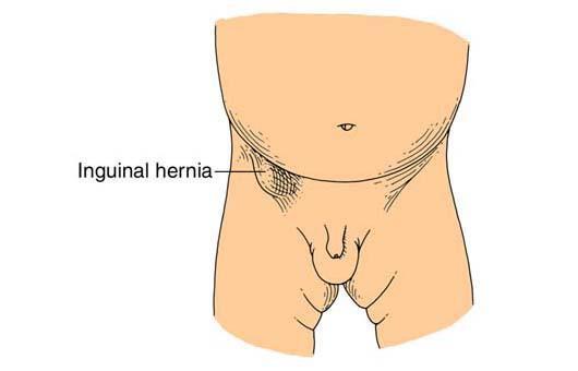 - Clinical presentation if the hernia become obstructed: Pain, tense swelling, vomiting.