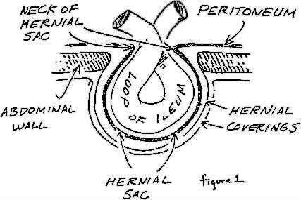 Definitions - A hernia is the protrusion of an organ through a defect in its containing wall.