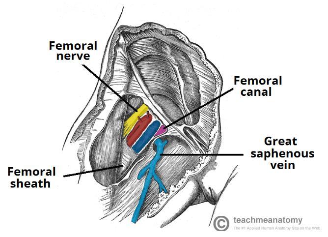 Femoral Hernia - A femoral hernia is the protrusion of extra peritoneal fat / a peritoneal sac / abdominal contents through the femoral canal.