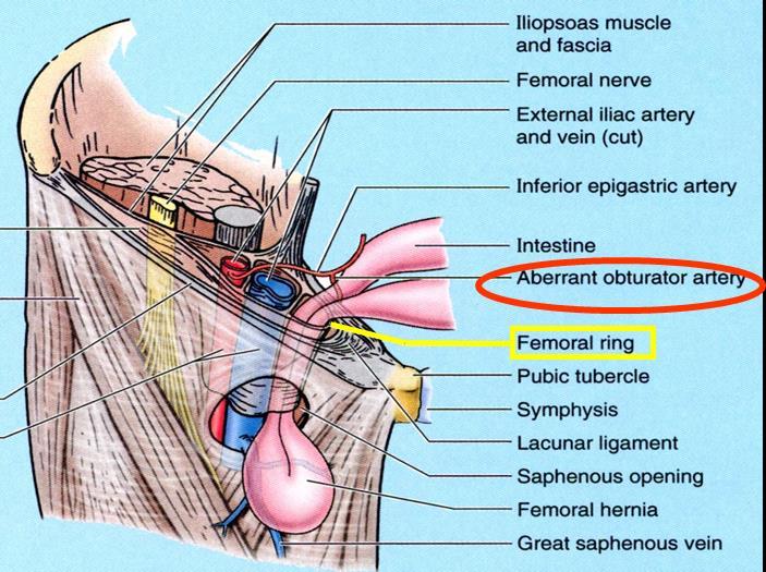 herniate. * Femoral Canal Anatomy: (Boundaries) Ant. inguinal ligament Post. Pubic ramus + pectineus muscle Med. Lacunar ligament + pubic bone Lat.