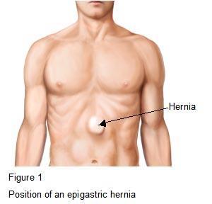 Epigastric Hernia - It's a protrusion through a defect in linea Alba somewhere between the xiphisternum and the umbilicus.