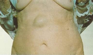 - The patient complains of epigastric pain localized at site of the hernia and may not notice the lump.