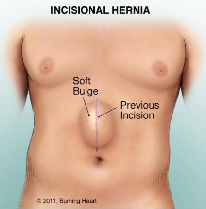 Incisional Hernia - It's a hernia through an acquired scar in the abdominal wall, caused by a previous surgical operation or injury.