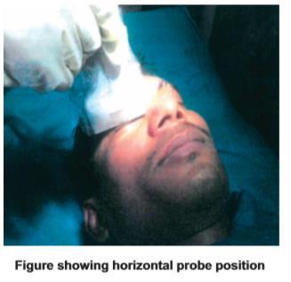 5 MHZ) probe was lightly placed horizontal over the closed upper eyelid of the patient on both the sides.