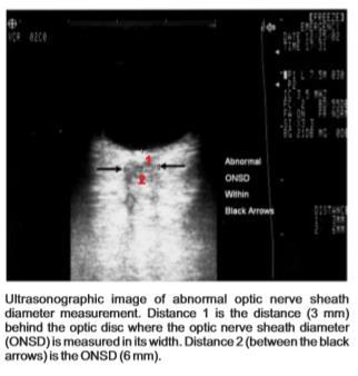 Based on prior literature, an above 5 mm on ultrasound considering abnormal, binocular > 5.00 mm was considered abnormal 4,5,6.