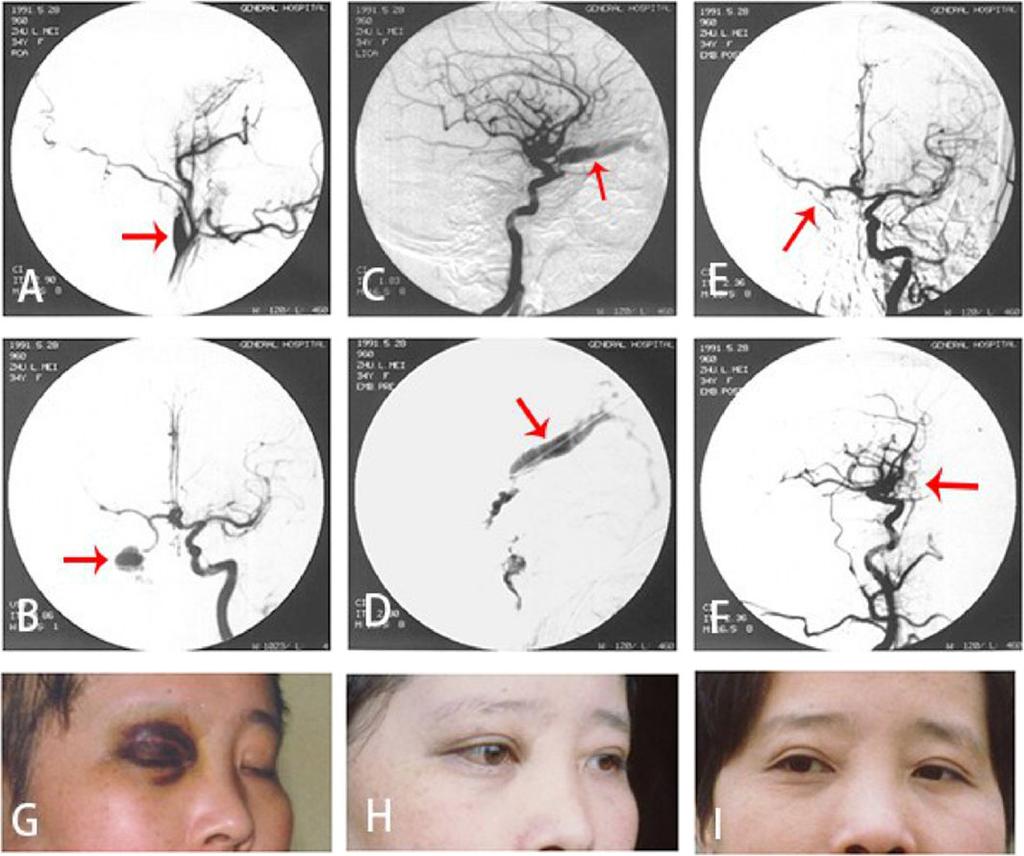 Pan et al. Chinese Neurosurgical Journal (2018) 4:26 Page 3 of 6 Fig. 3 The DSA and clinical symptoms before and after the embolization of right ICA cavernous sinus fistula.