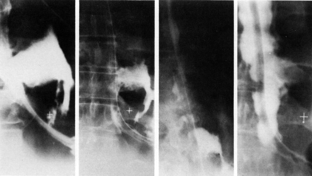 406 The Annals of Thoracic Surgery Vol 27 No 5 May 1979 A C D Fig 2. (A) Gastrografin (meglucamine diatrizoate) swallow in a 53-year-old man 7 days following esophageal operation.