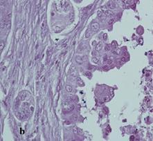 1a: Low power view showing Invasive ductal carcinoma (grade2). (X100, H&E) Fig.