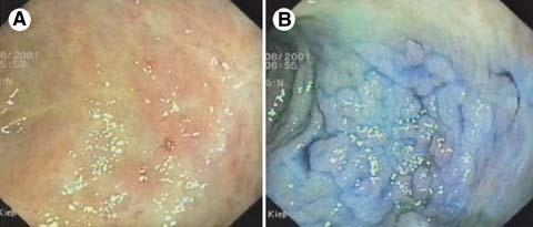 Chromoendoscopy in Inflammatory Bowel Disease Ralf Kiesslich, Markus F. Neurath, MD Author Year Country Dye Staining Endoscopy Design No. of pts. Pts. with dysplasia Outcome chromo vs.