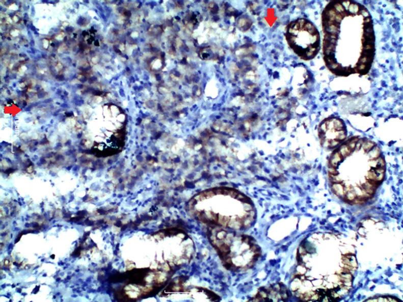 Fig. 1: Loss of E-Cadherin immunostaining in Lauren s diffuse type gastric adenocarcinoma (red arrows) with positively staining normal gastric mucosal glands (HEx400) Fig.