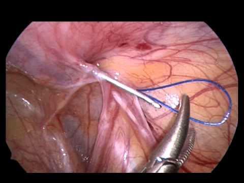 5 cm Lap or open Medium <8cm laparoscopic (Suture closed).