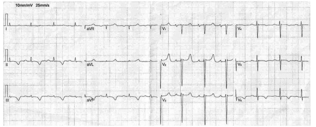 Case Report A 62-year-old woman was admitted to our hospital with respiratory distress and cyanosis, complaining of orthopnea and paroxysmal nocturnal dyspnea.
