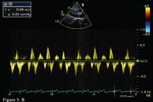 Pulsed-wave Doppler echocardiography demonstrates a