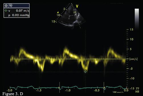 (B). Tissue Doppler echocardiography reveals annulus