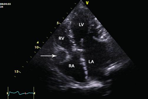 AO, Aorta; LA, Left atrium; LV, Left ventricle; PW,