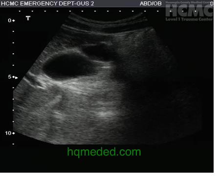 dimension Gallbladder Scanning Ultrasound Views of the