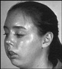 Long Face Syndrome Montelukast: Randomized, double blind for 6 weeks Features Vertical height Gummy smile High arched palate Steep mandibular plane