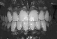 High-arched Narrow maxilla 90% of
