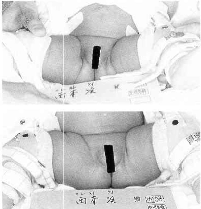 ) The incidence was 12 right, 17 left and one bilateral. Grade 1 acetabular dysplasia was found in 27 cases with 3 cases of normal development.
