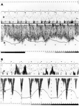296 Kaulitz, Bergman, Luhmer, et al Figure 1 Pulsed Doppler recording from the superior caval vein (A) and hepatic vein (B) in a patient after total cavopulmonary anastomosis.