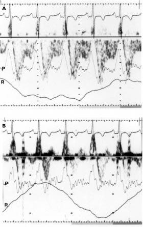 Venous pressure flow velocity relations in univentricular circulation 297 Figure 2 Pulsed Doppler recording from the superior caval vein (A) and hepatic vein (B) in a patient after an atriopulmonary