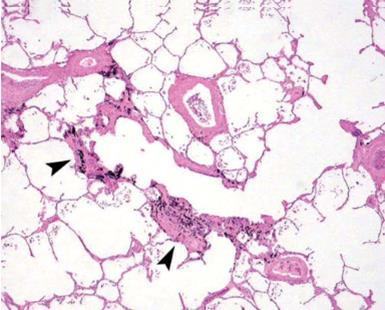 Asbestosis histologic criteria 1982 CAP-NIOSH Fibrosis foci in the wall of the bronchioles associated with the presence of asbestos bodies 1997 - Helsinki Fibrous foci in the wall of the bronchioles