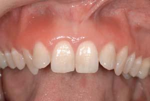 Fig 1a Bilateral, patchy erythematous lesions, in the maxillary lateral incisor/canine region and affecting the free and attached gingivae and also extending to the non-keratinised reflected oral