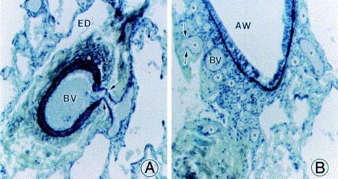 associated with histologic transitions Starnes SL, 2000 Microvessel Density: rat model Histology Sparse data: Weber Osler Rendu complex vs BDG vs hepatic cirrhosis Lung Biopsy Micrographs