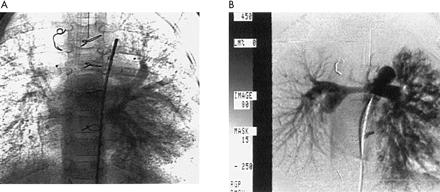 Effect of Incorporation of Hepatic Veins after Kawashima Operation but not always Specific Angiogenic Factors: VEGF Diffuse bilateral AVMs Unilateral progression despite incorporation of hepatic