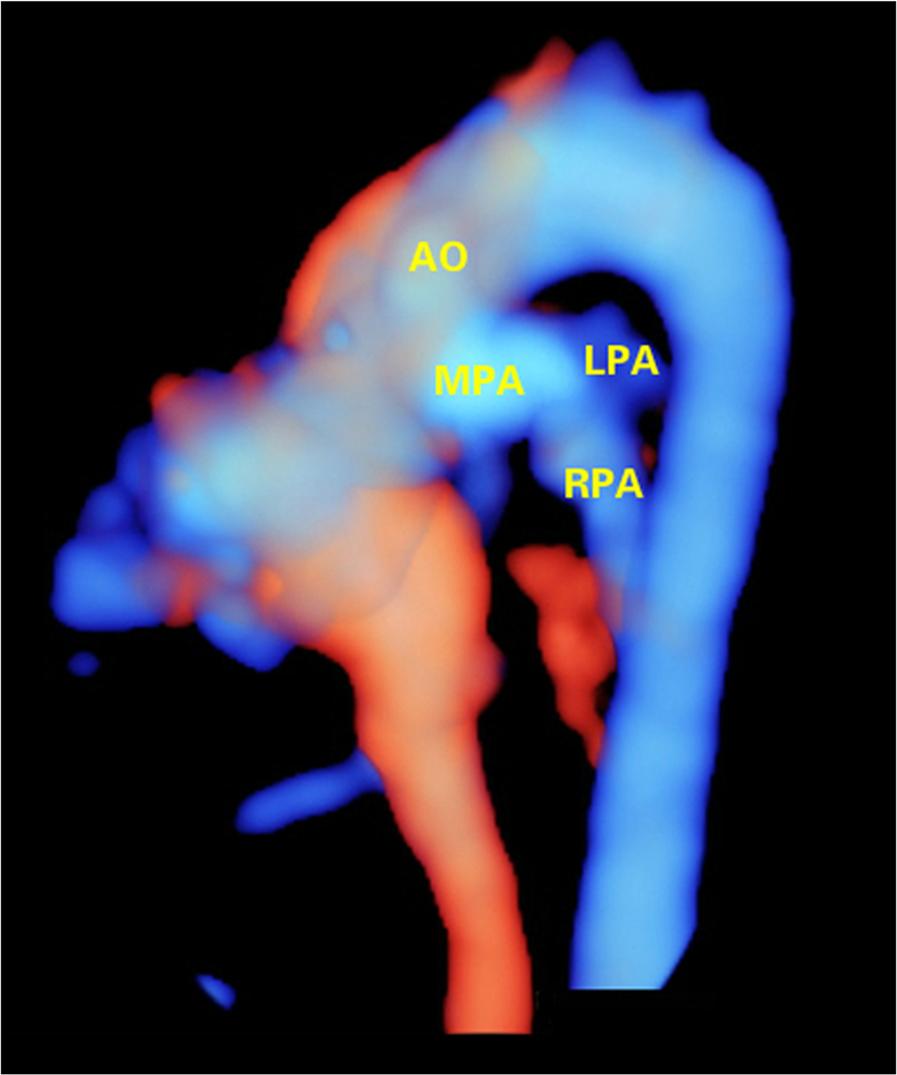 Wang et al. Cardiovascular Ultrasound (2017) 15:17 Fig. 8 Detection of TCA in a fetus of 28 gestational weeks using 4D volumes with color flow information.
