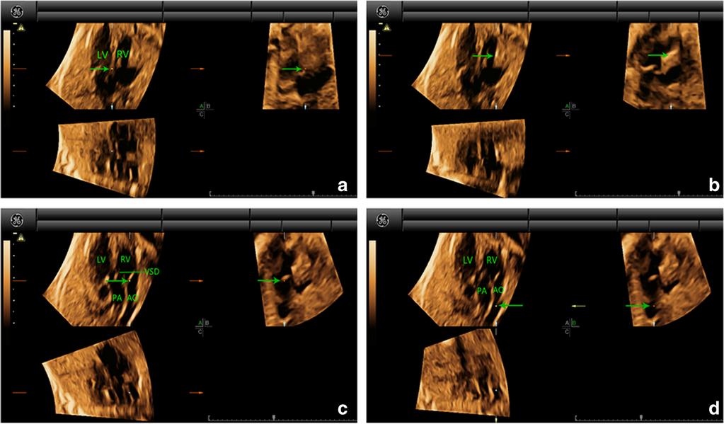 Wang et al. Cardiovascular Ultrasound (2017) 15:17 Page 5 of 13 Fig. 2 Multiplanar slicing of TGA in a fetus of 25 gestational weeks.