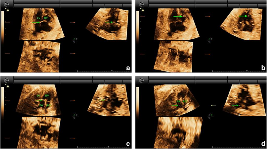 Wang et al. Cardiovascular Ultrasound (2017) 15:17 Page 6 of 13 Fig. 3 Multiplanar slicing of DORV in a fetus of 26 gestational weeks.