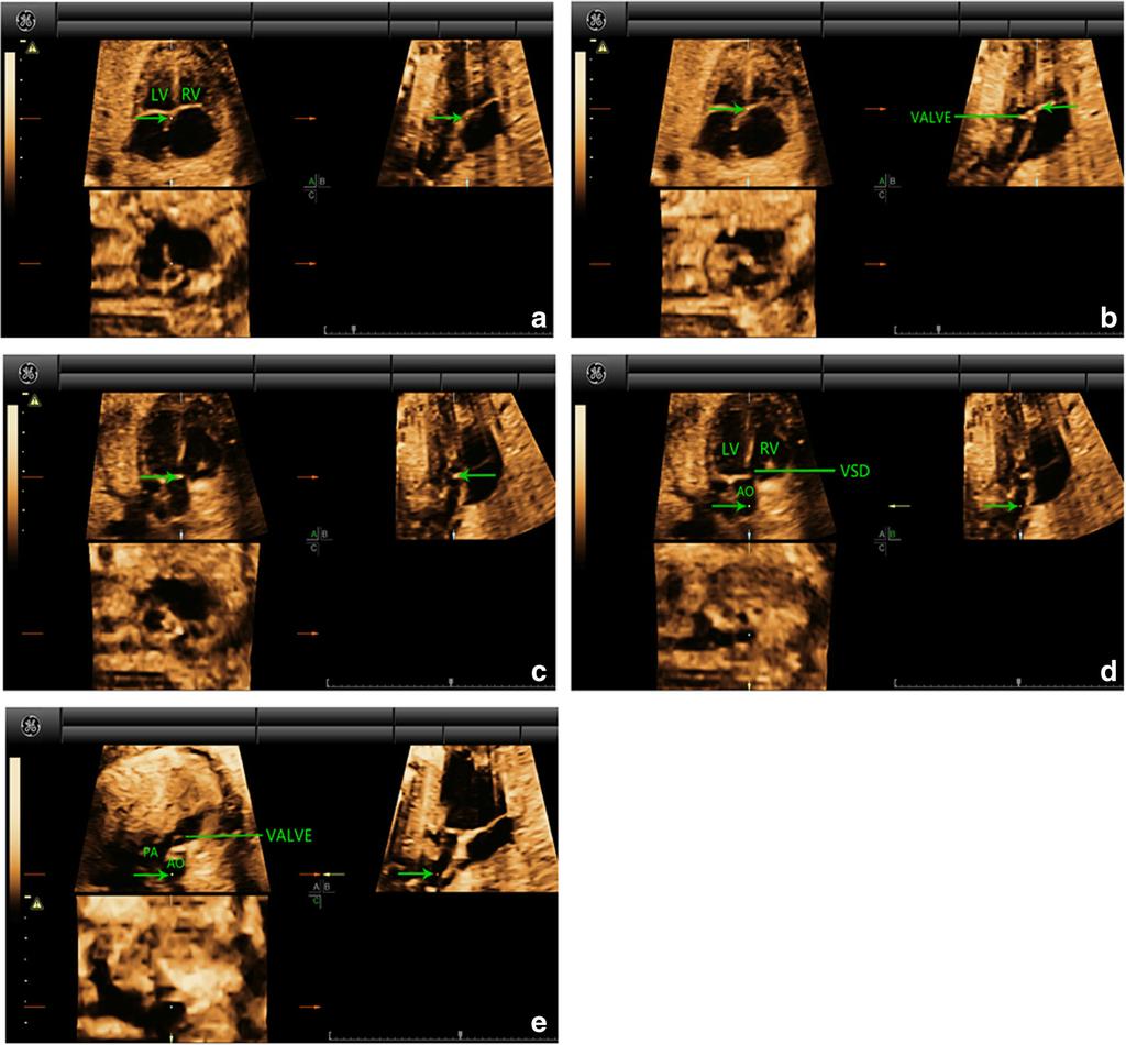 Wang et al. Cardiovascular Ultrasound (2017) 15:17 Page 7 of 13 Fig. 4 Multiplanar slicing of TOF in a fetus of 24 gestational weeks.