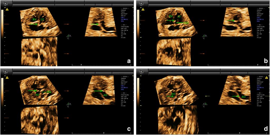 Wang et al. Cardiovascular Ultrasound (2017) 15:17 Page 8 of 13 Fig. 5 Multiplanar slicing of TCA in a fetus of 28 gestational weeks.