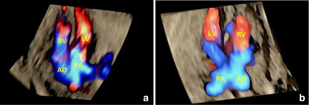 Wang et al. Cardiovascular Ultrasound (2017) 15:17 Page 9 of 13 Fig. 6 Detection of great arteries alignment in TGA and normal fetuses using 4D volumes with color flow information.