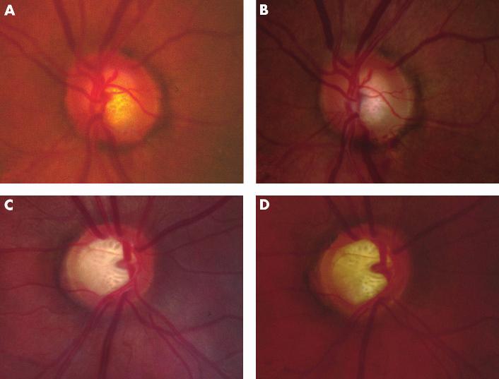 Lamina cribrosa pores in glaucomatous eyes 253 Table 2 Change in morphological characteristics during follow up* Characteristics No (%) % change Vertical cup to disc ratioà 9 (23.1) 6.51 (2.