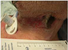 under device (C/2) Ulcers from Foley From trach ties Assess all skin folds regularly. (C/2) Access adequate assistance (C/2) Differentiate intertriginous dermatitis from Stage 1 and 2 pressure ulcers.