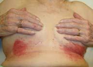fold breakdown Associated with sweating Common skin folds include breasts, groin, beneath skin folds May have bacteria and