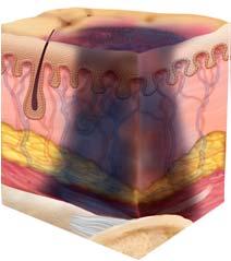 Tissue Pressure Injury: Persistent non-blanchable deep red, maroon or purple