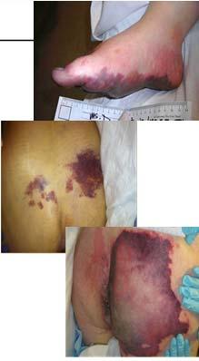deep red, maroon, purple discoloration or epidermal separation revealing a dark wound bed