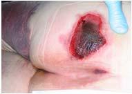 extent of tissue injury, or may resolve without tissue loss.