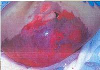 diseases with purple hues or rapid eschar formation Pyoderma Calciphylaxis Lymphedema