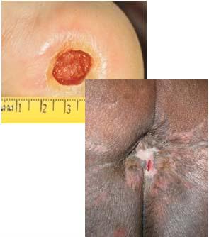 Wound bed in a Stage 3 Pressure Injury Ulcer surface appearance Full thickness