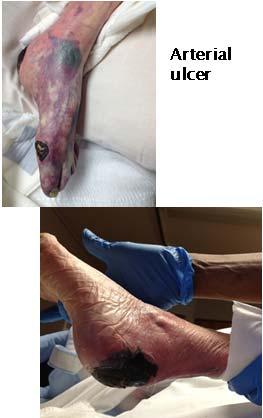 Necrotic wounds in distal tissue in limbs with poor perfusion Painful
